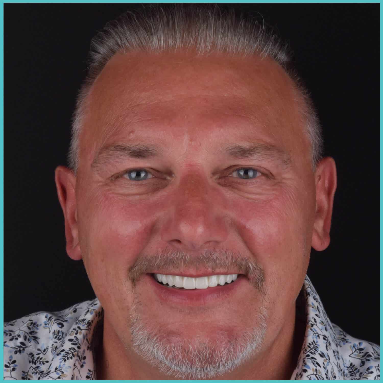 komplette zahnimplantate mit fly2smile