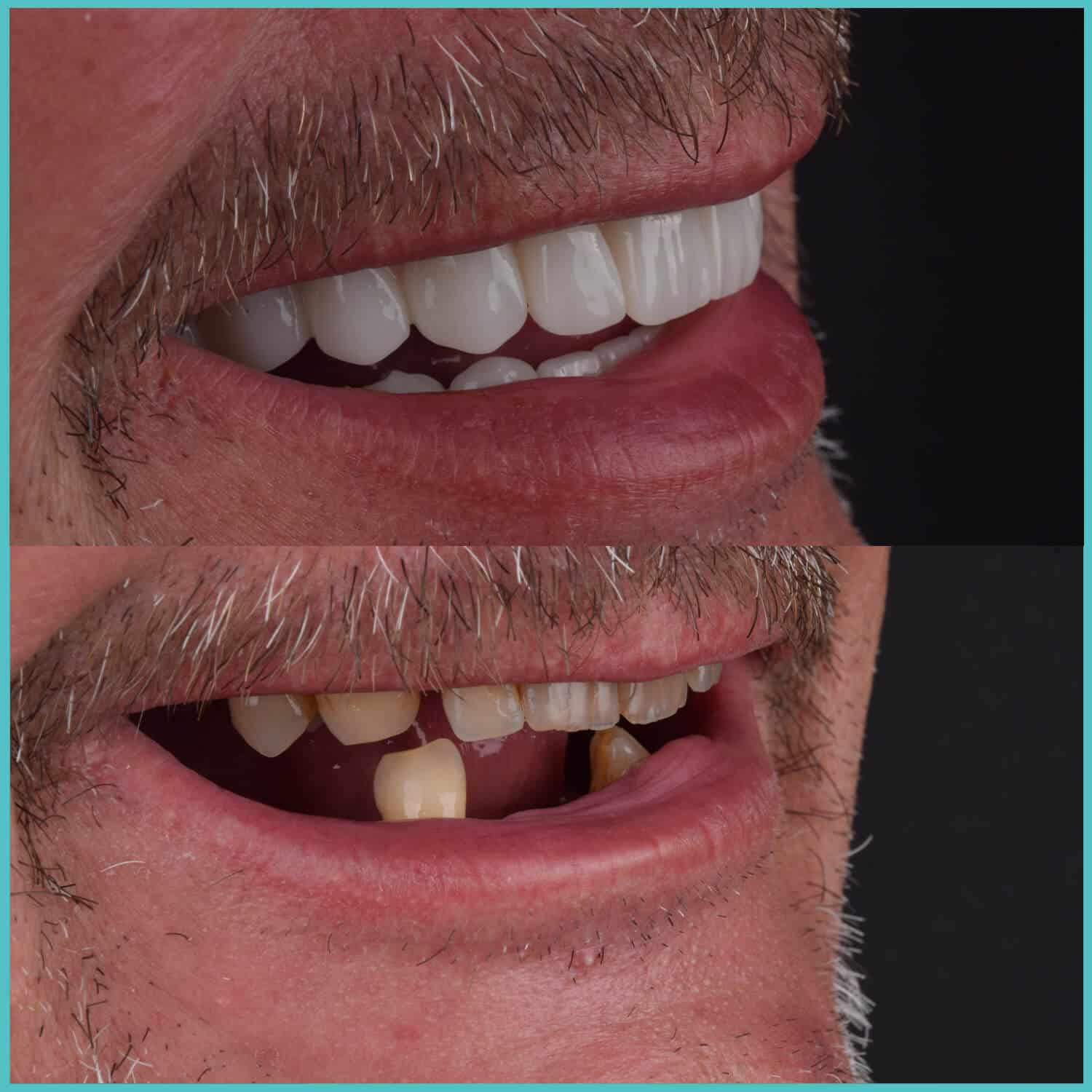 komplette zahnimplantate mit fly2smile