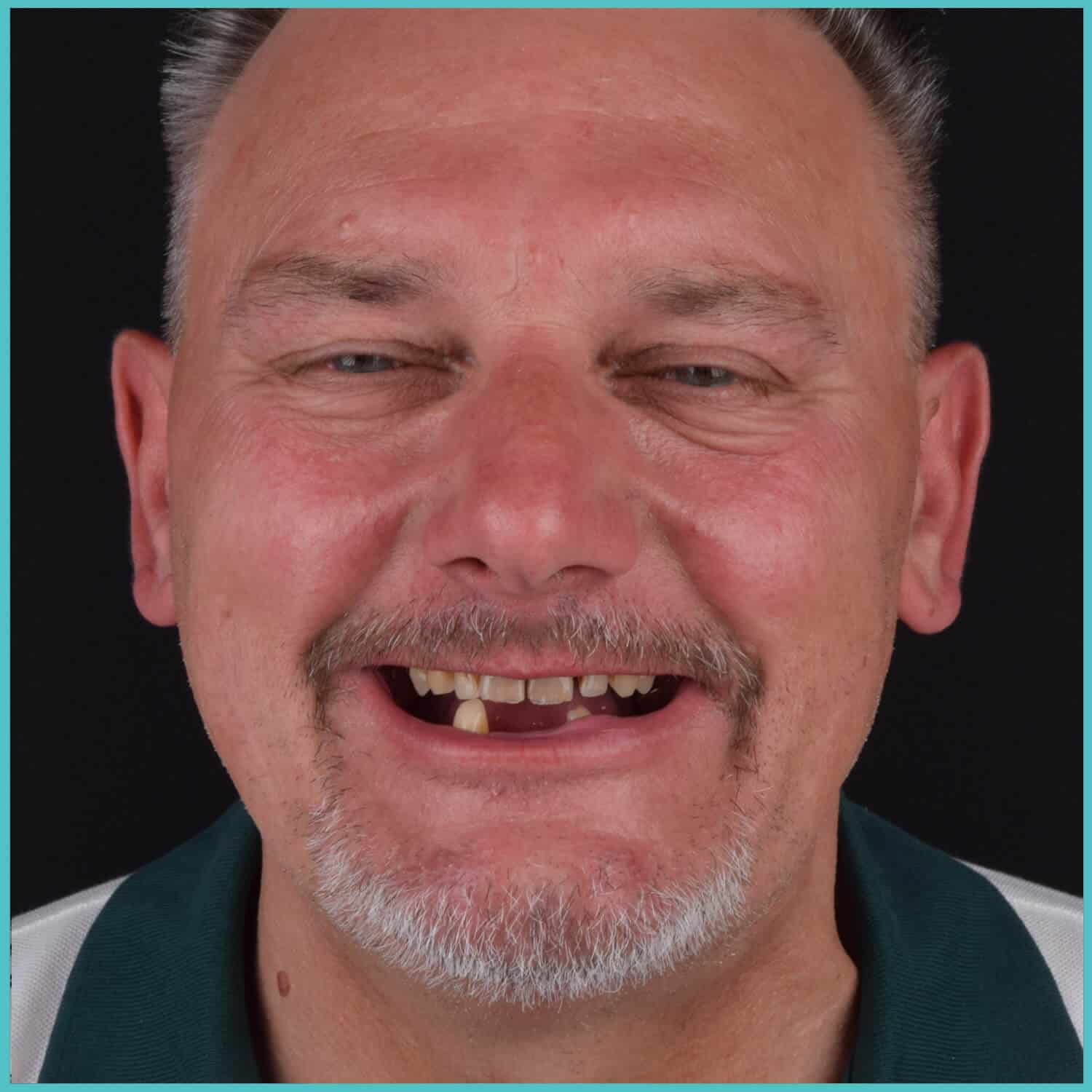 komplette zahnimplantate mit fly2smile