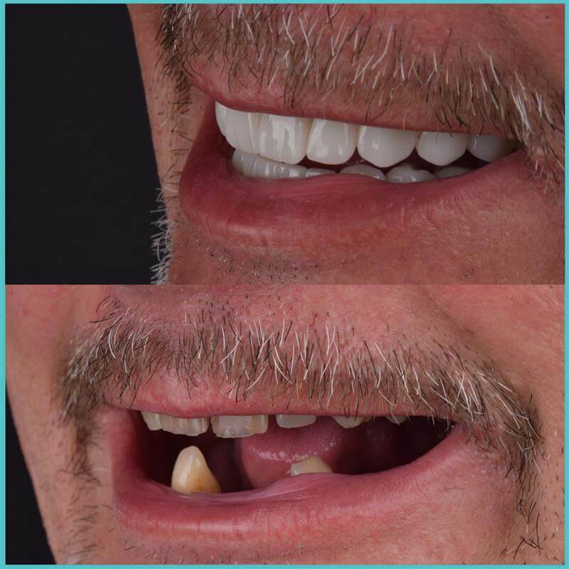 komplette zahnimplantate mit fly2smile