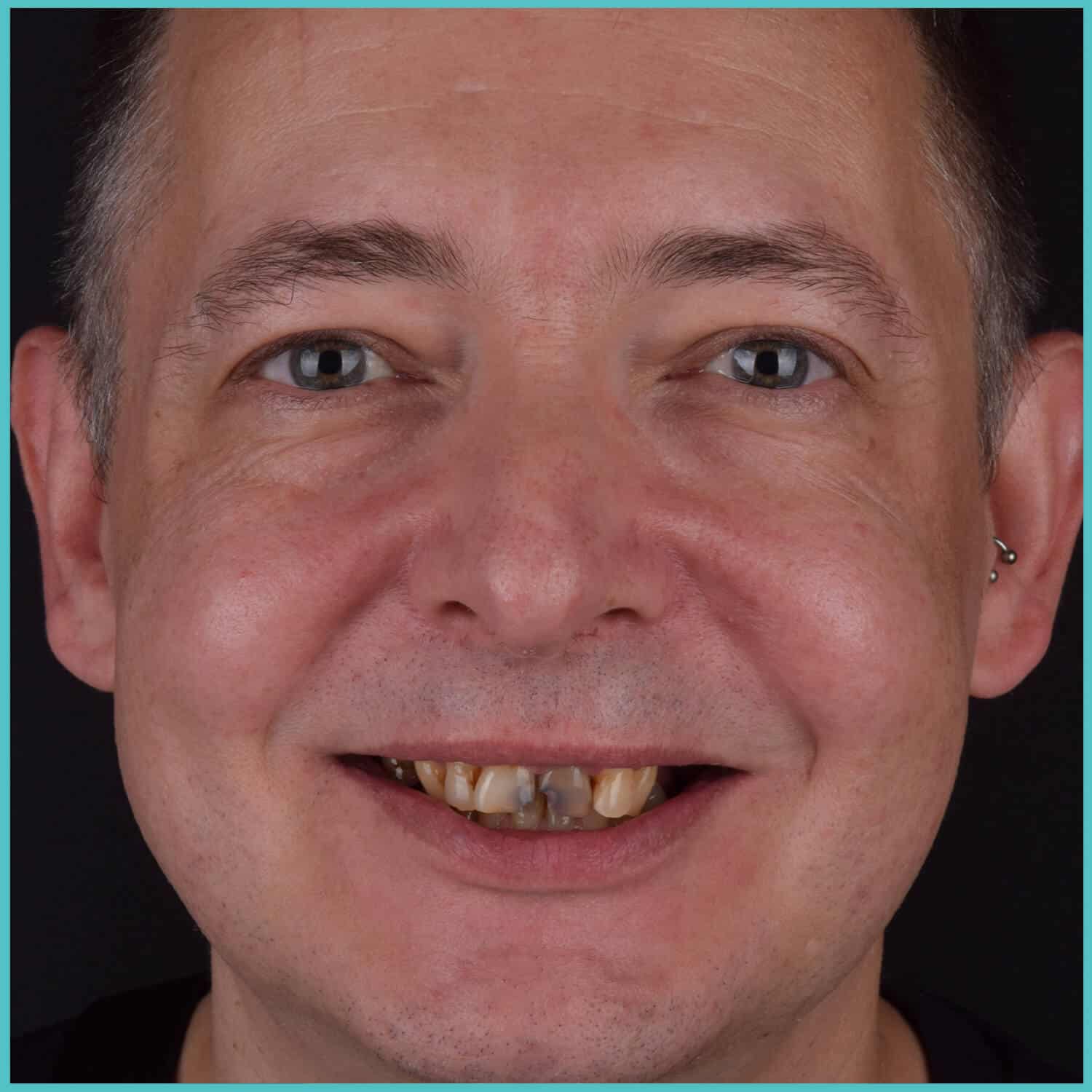 komplette zahnimplantate mit fly2smile