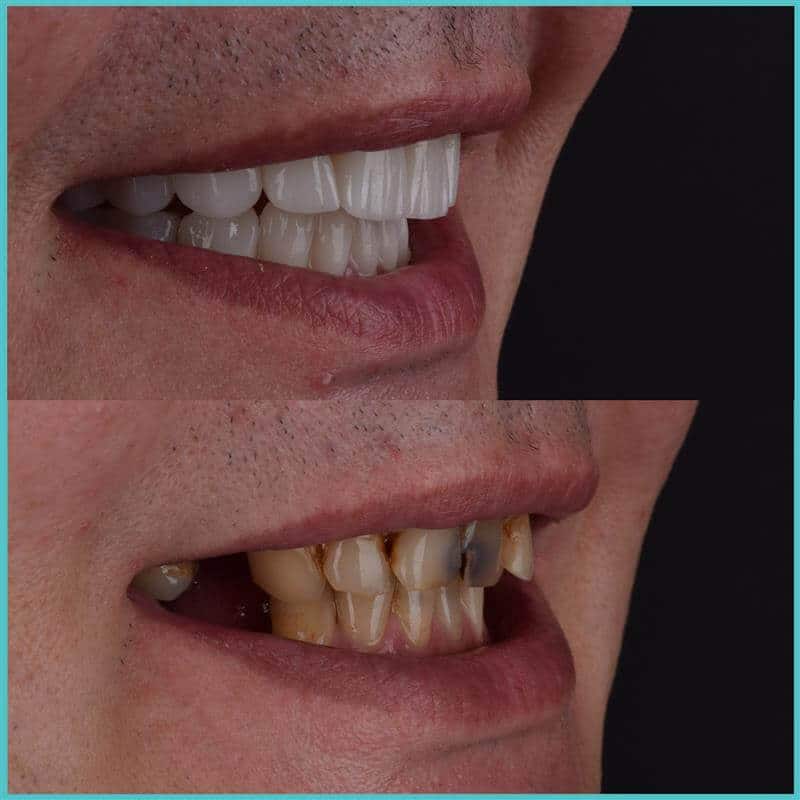 komplette zahnimplantate mit fly2smile