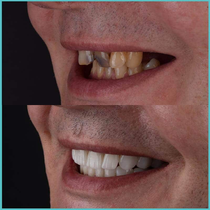 komplette zahnimplantate mit fly2smile