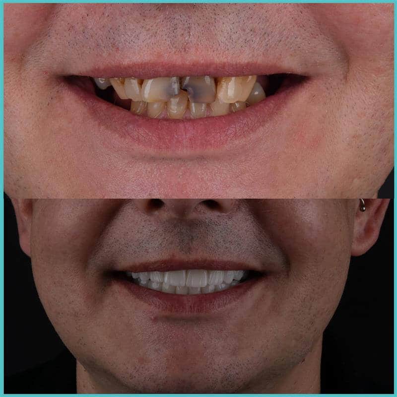 komplette zahnimplantate mit fly2smile