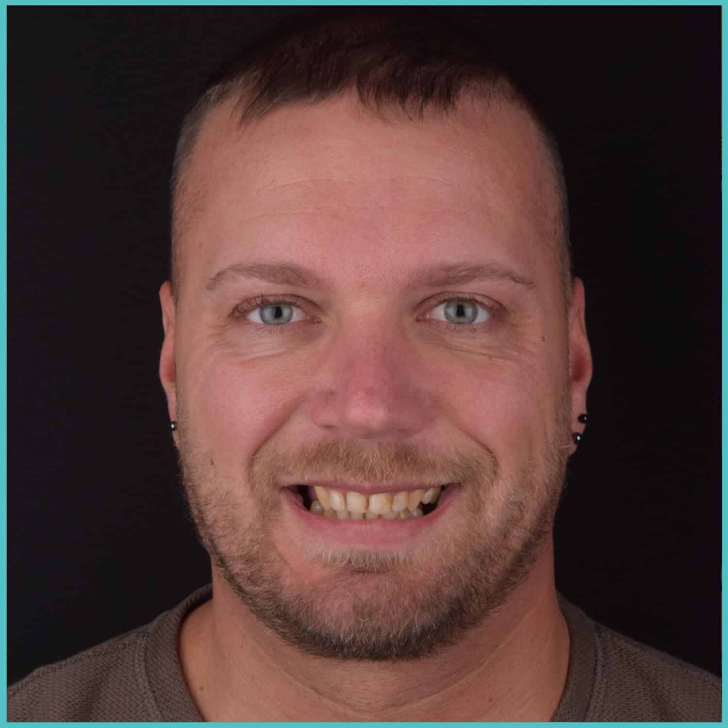 komplette zahnimplantate mit fly2smile