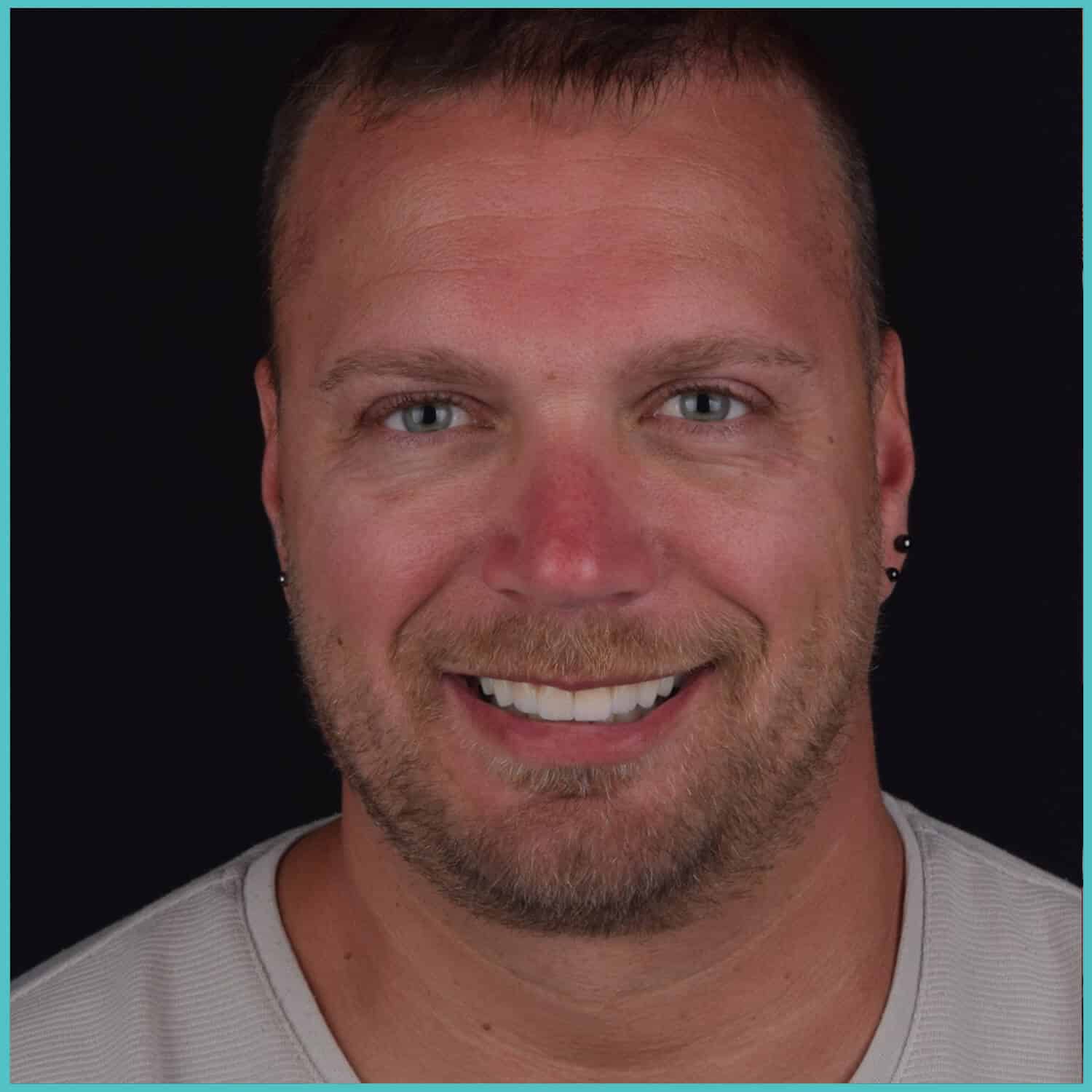 komplette zahnimplantate mit fly2smile