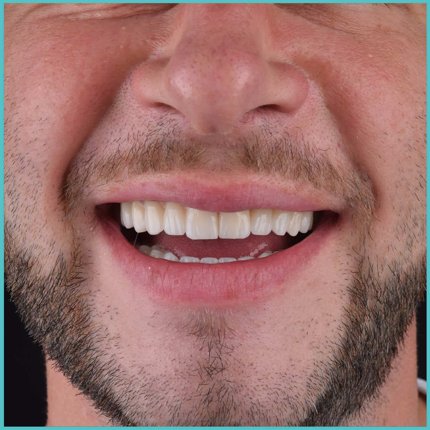 komplette zahnimplantate mit fly2smile