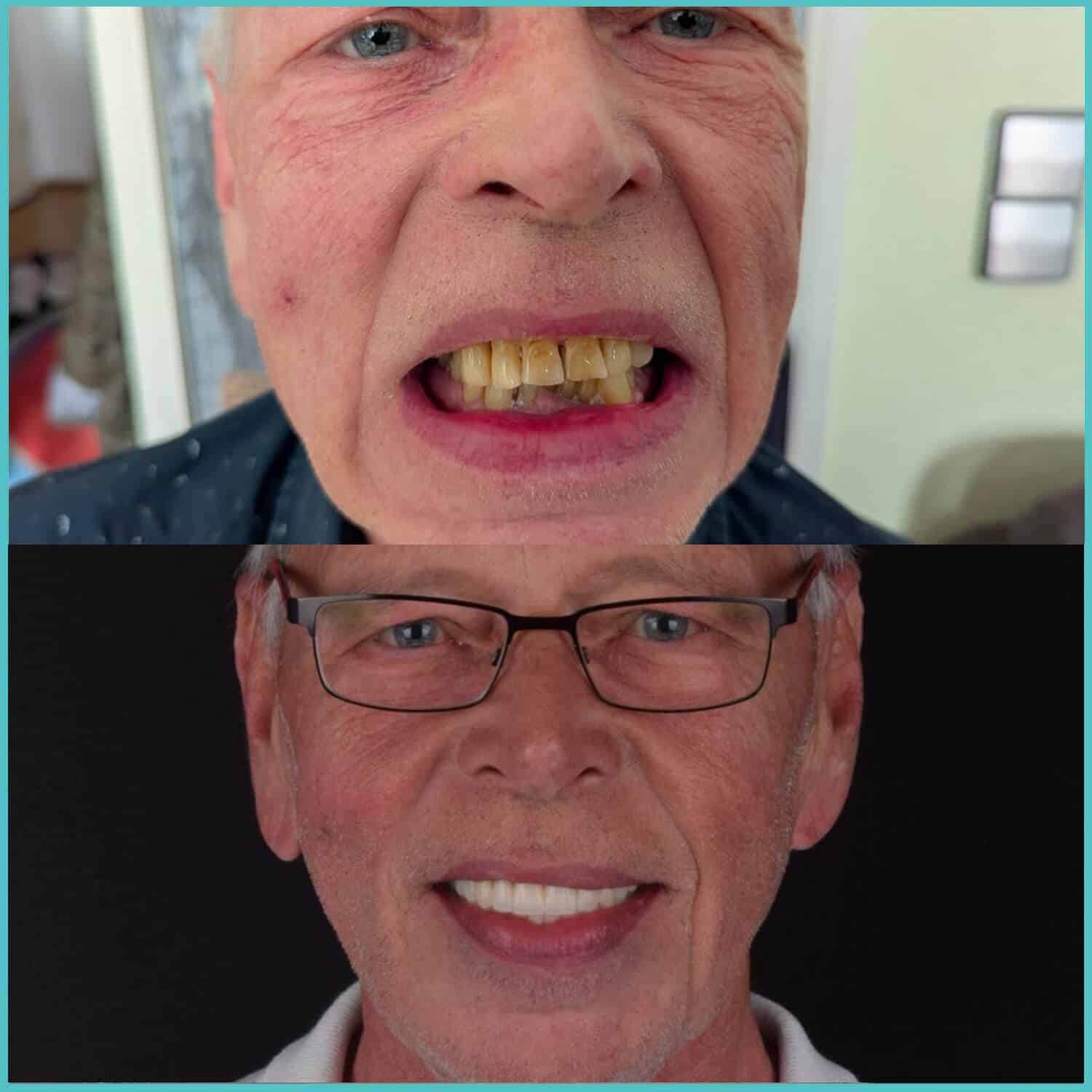 komplette zahnimplantate mit fly2smile