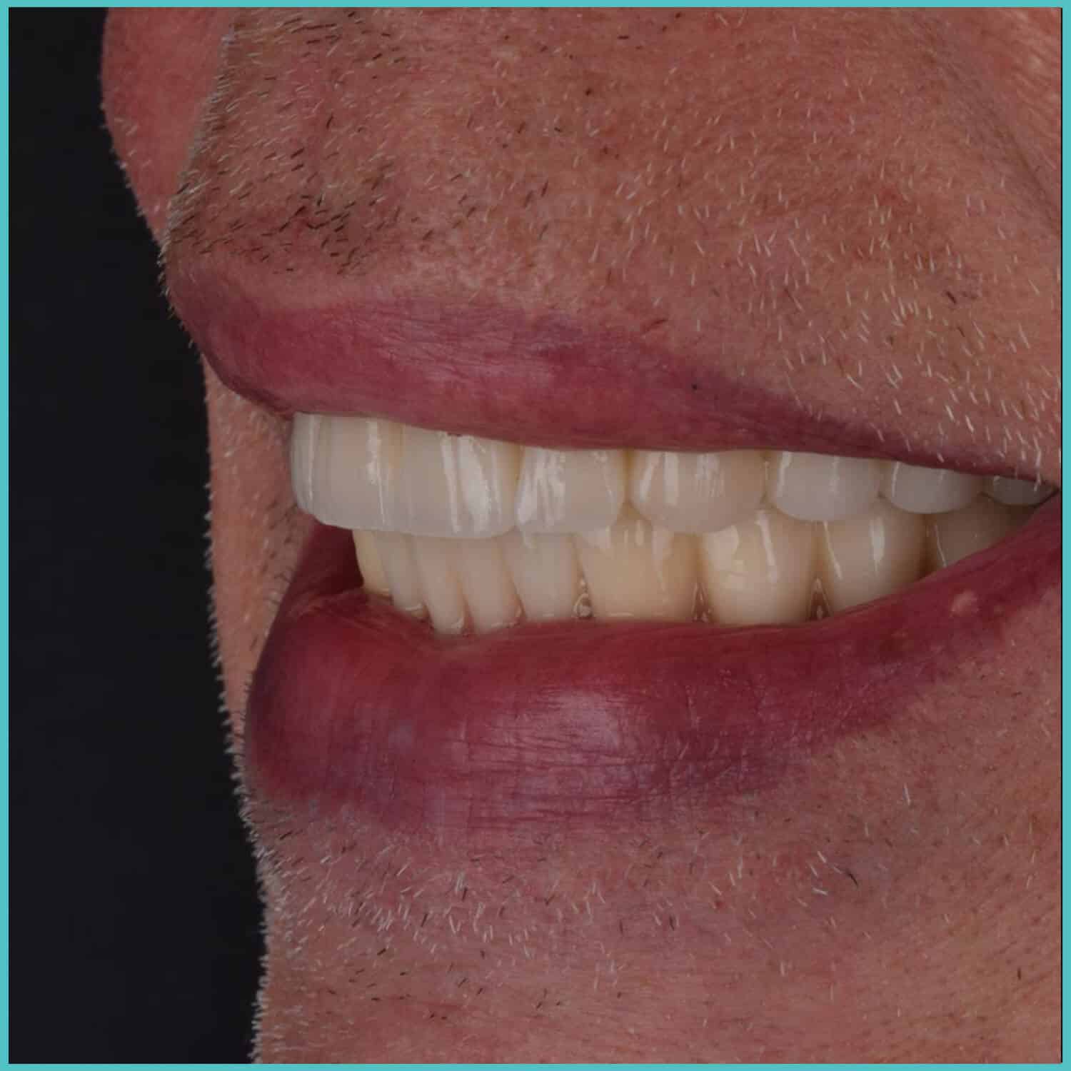 komplette zahnimplantate mit fly2smile