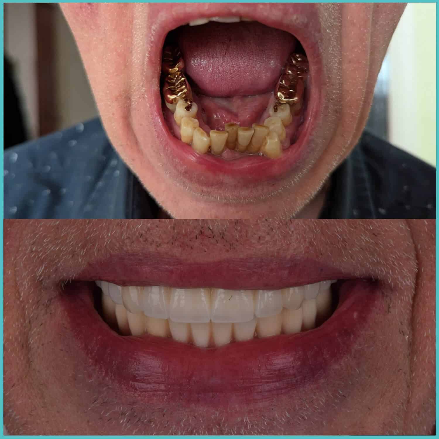 komplette zahnimplantate mit fly2smile