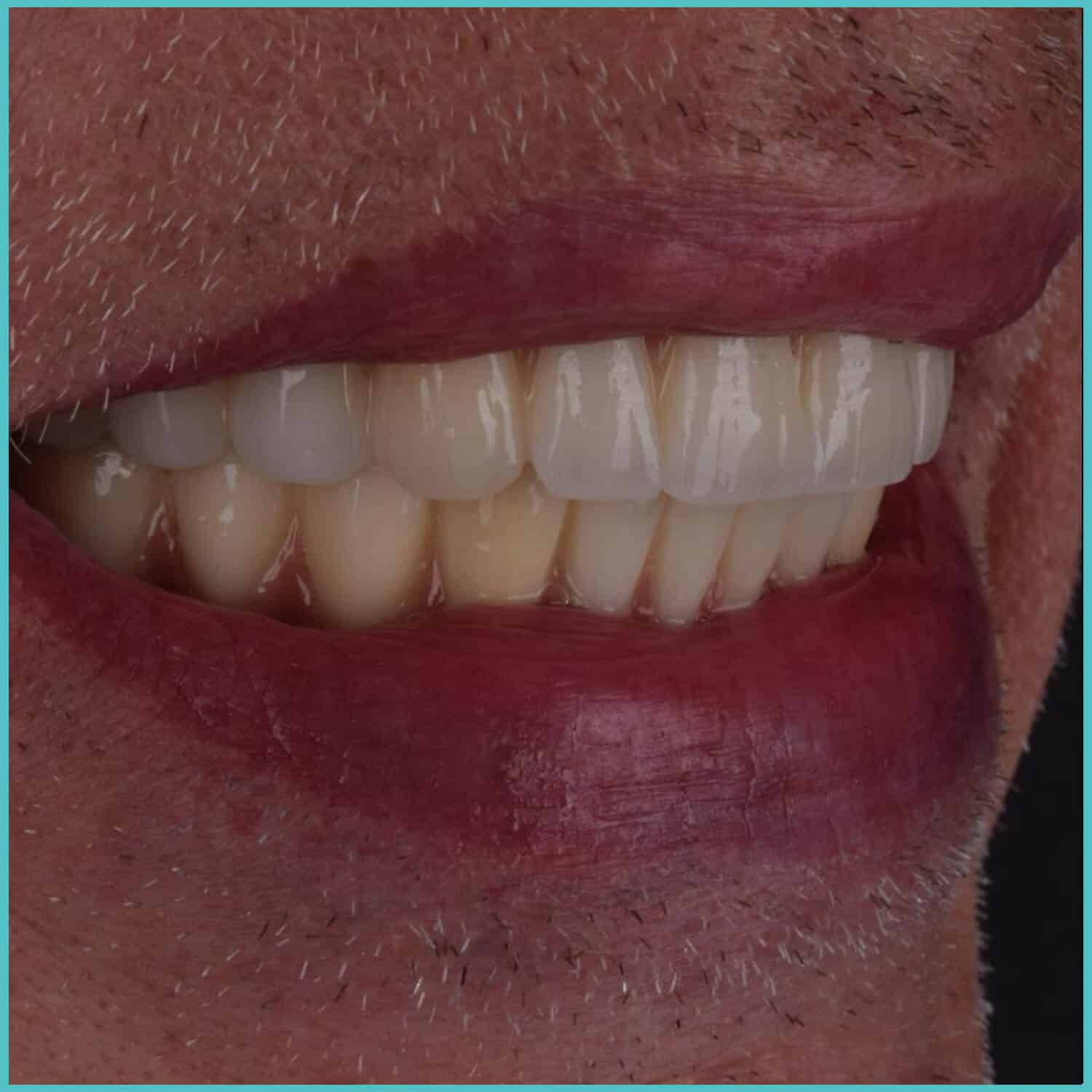 komplette zahnimplantate mit fly2smile