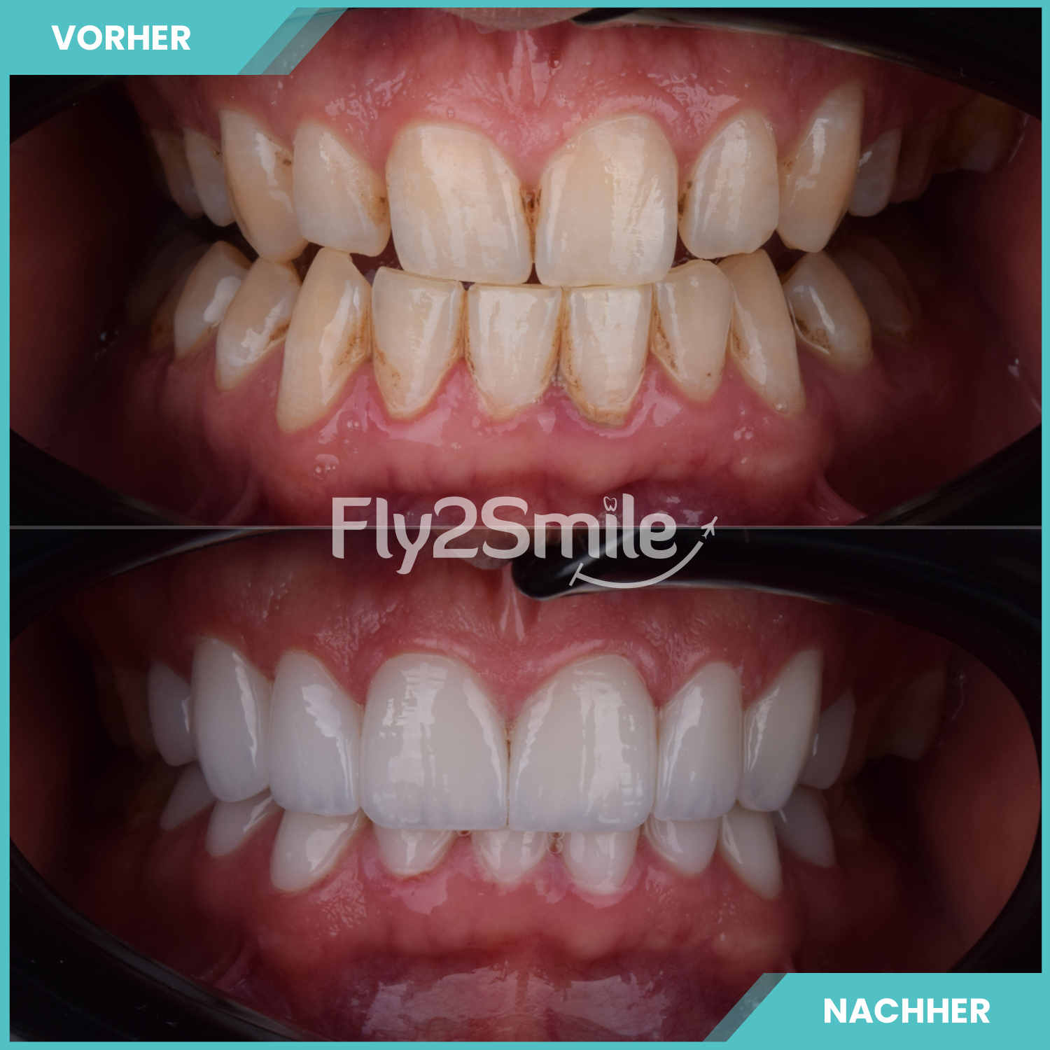 komplette zahnimplantate mit fly2smile