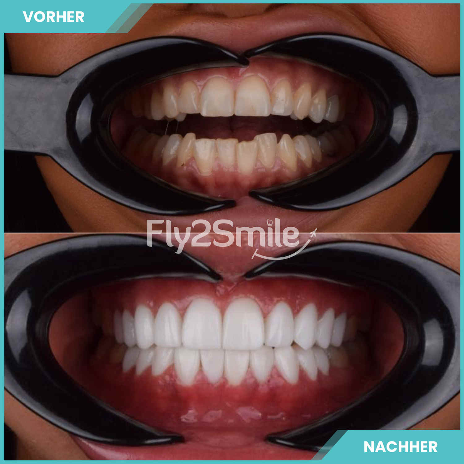 komplette zahnimplantate mit fly2smile