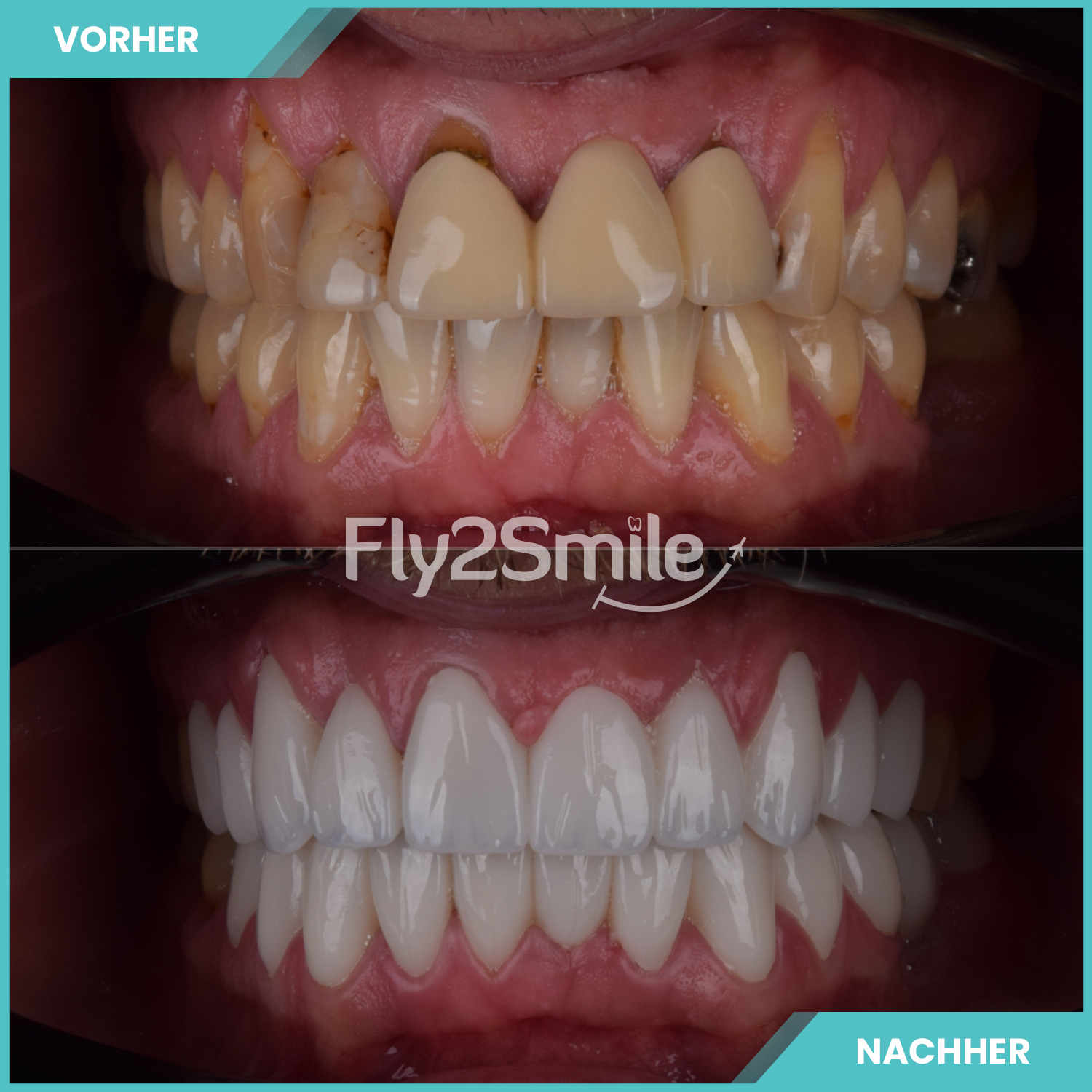 komplette zahnimplantate mit fly2smile