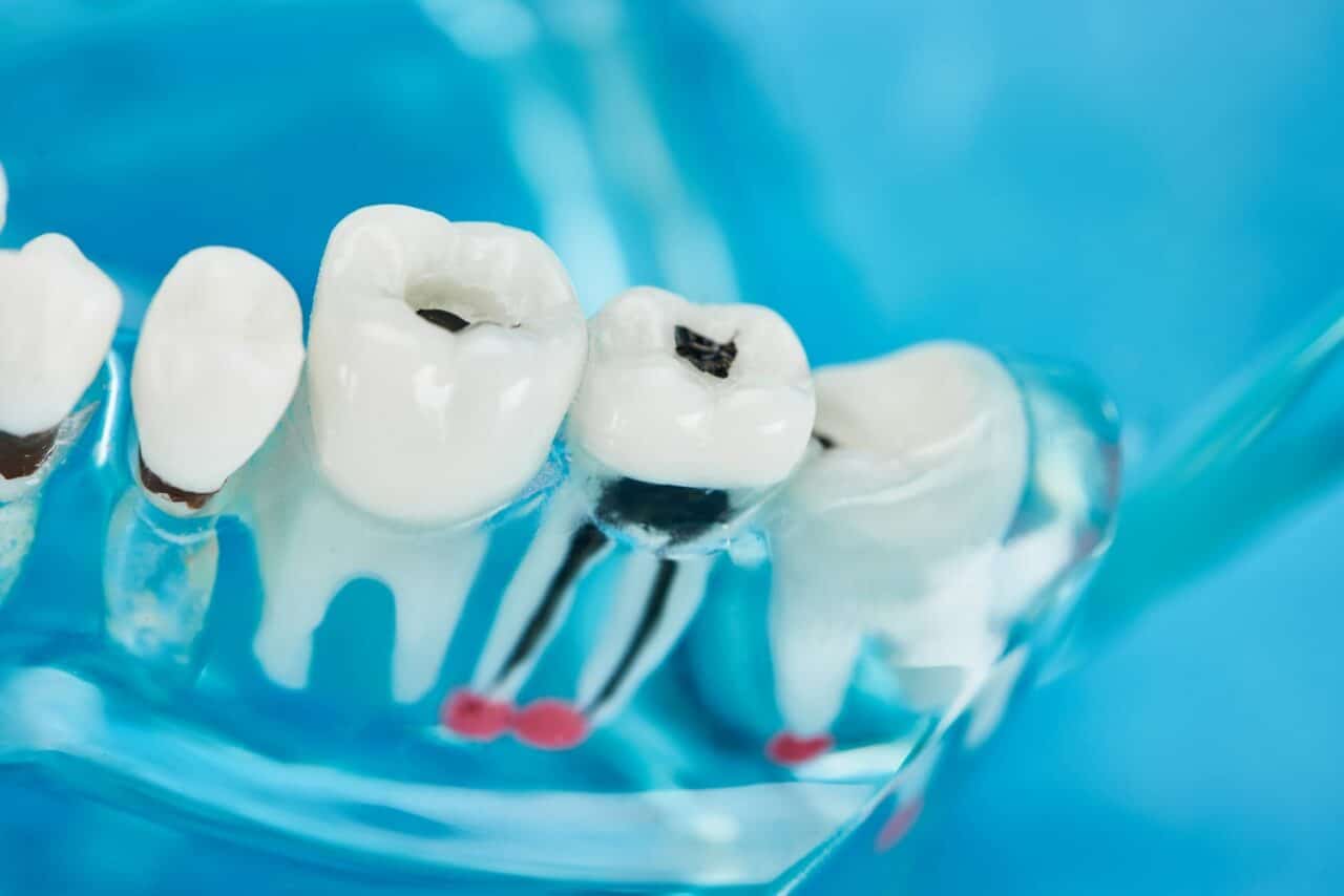 Schwarzer Punkt auf dem Zahn Was kann das bedeuten? Fly2Smile