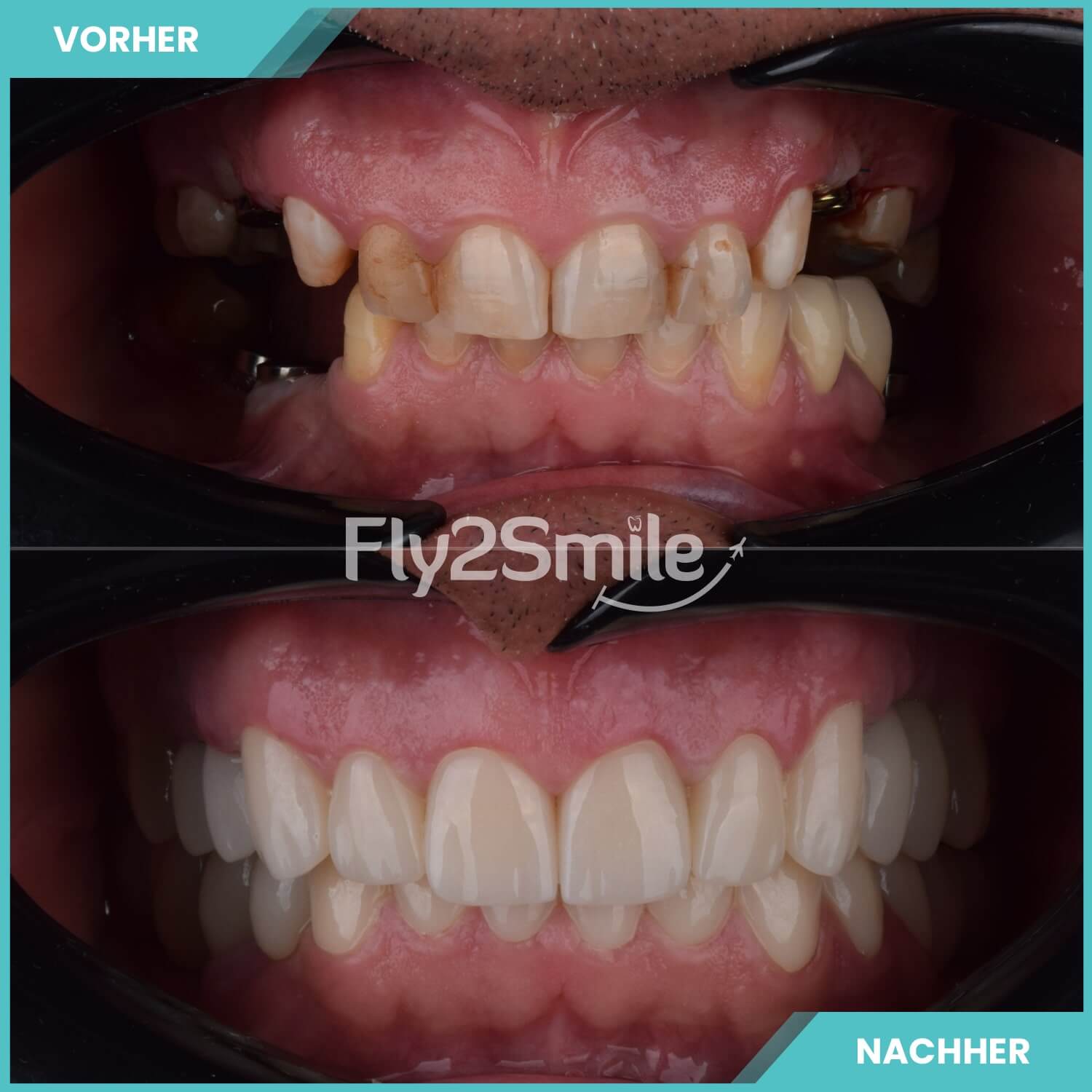 Zahnimplantate mit Fly2Smile