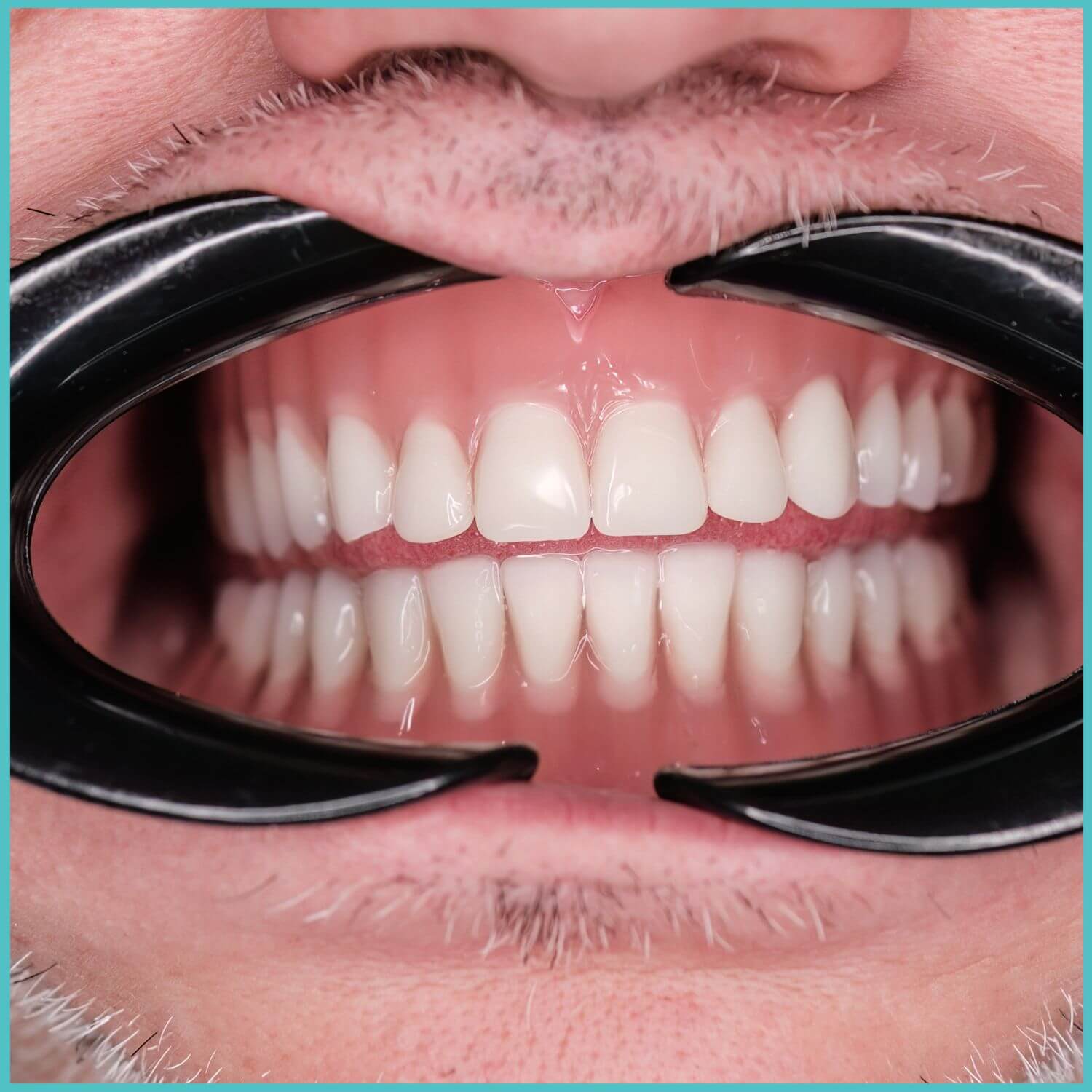 komplette zahnimplantate mit fly2smile