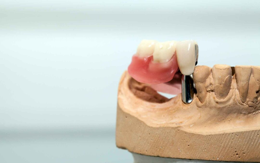 All-on-4 herausnehmbar – implantatgetragener Zahnersatz
