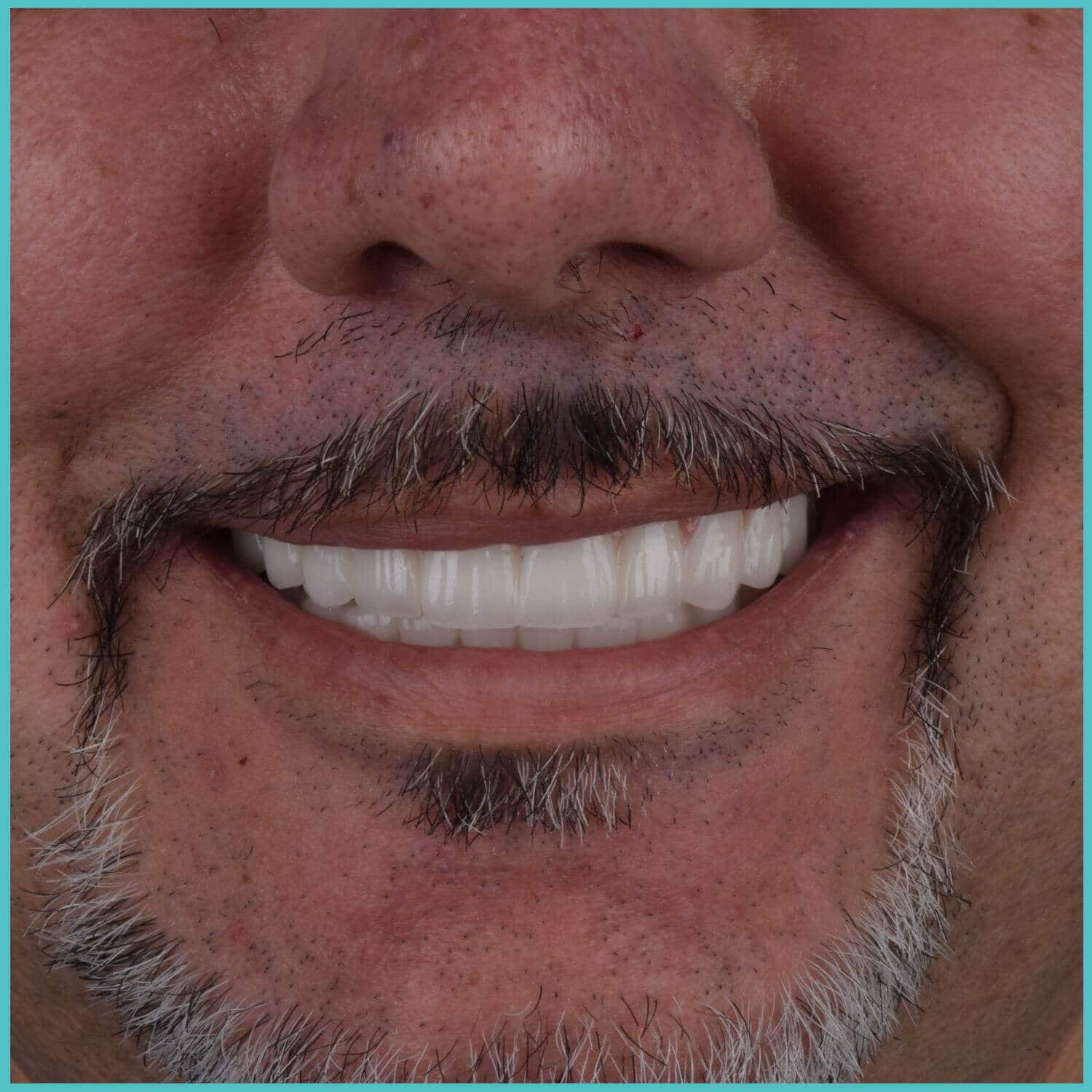 komplette zahnimplantate mit fly2smile