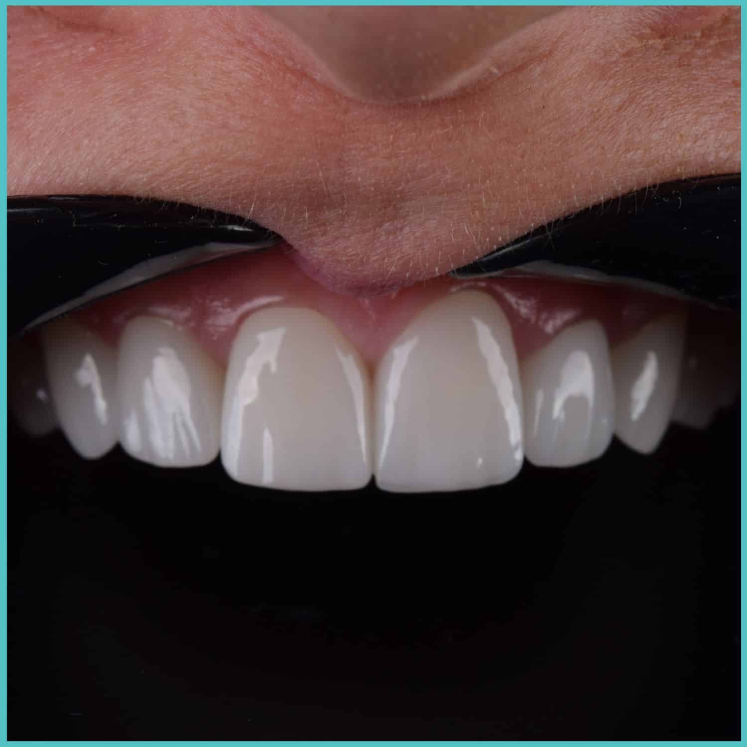 komplette zahnimplantate mit fly2smile