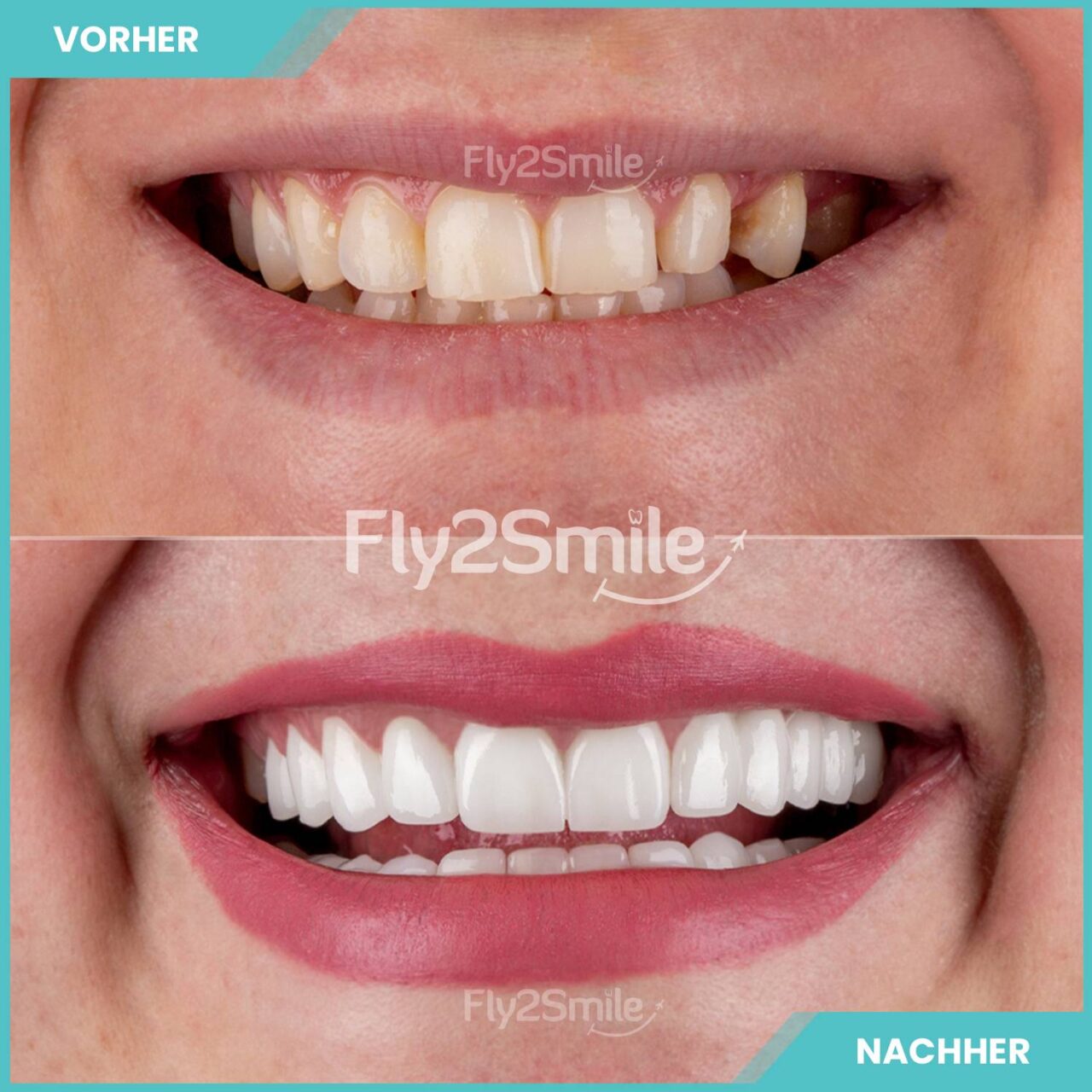 Sunshine Smile Vorher Nachher
