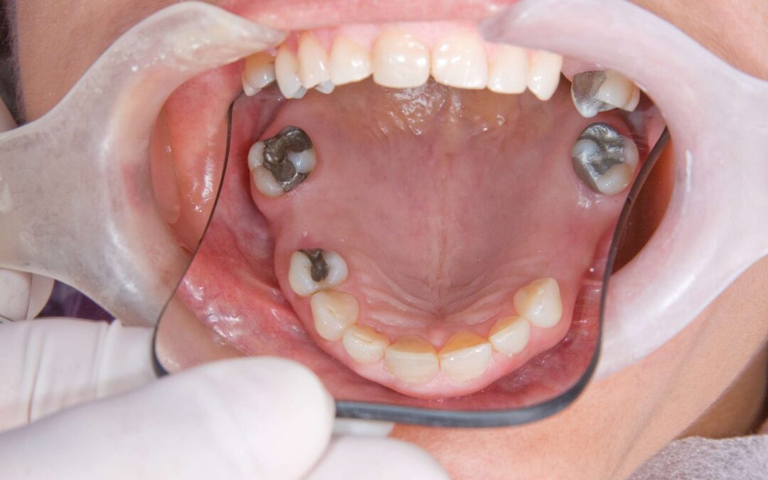 Unterkiefer-Zahnimplantate: Endlich wieder unbeschwert lachen