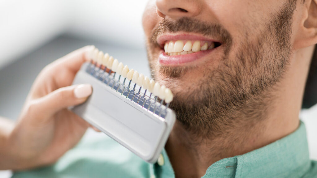 Veneers Türkei Beratung zur individuellen Planung eines ästhetischen und natürlichen Lächelns