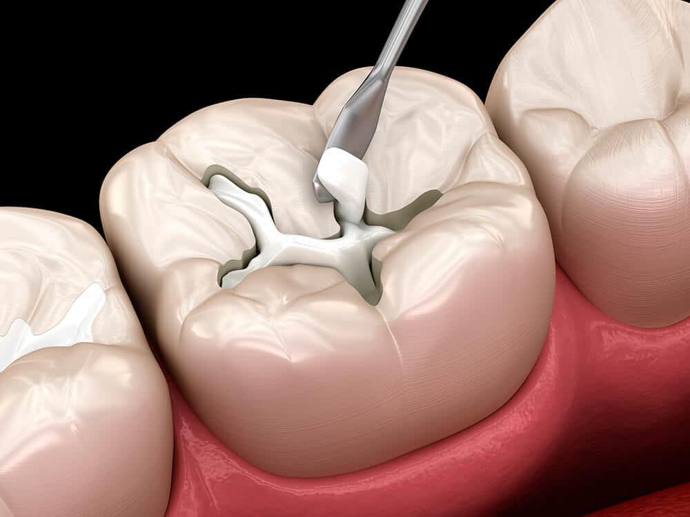 Zahnsanierung für die Wiederherstellung von Funktion, Zahngesundheit und einem ästhetischen Lächeln