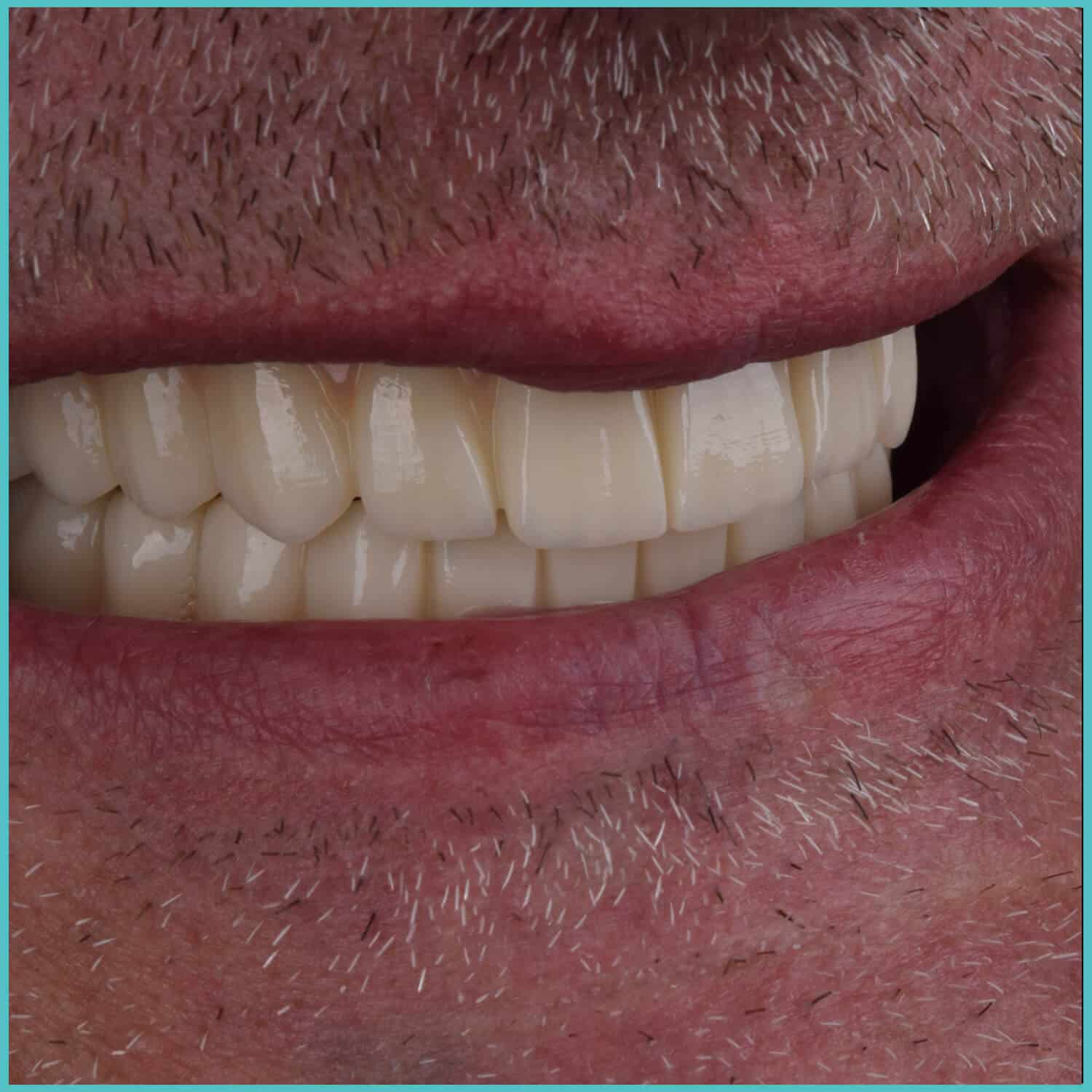 komplette zahnimplantate mit fly2smile