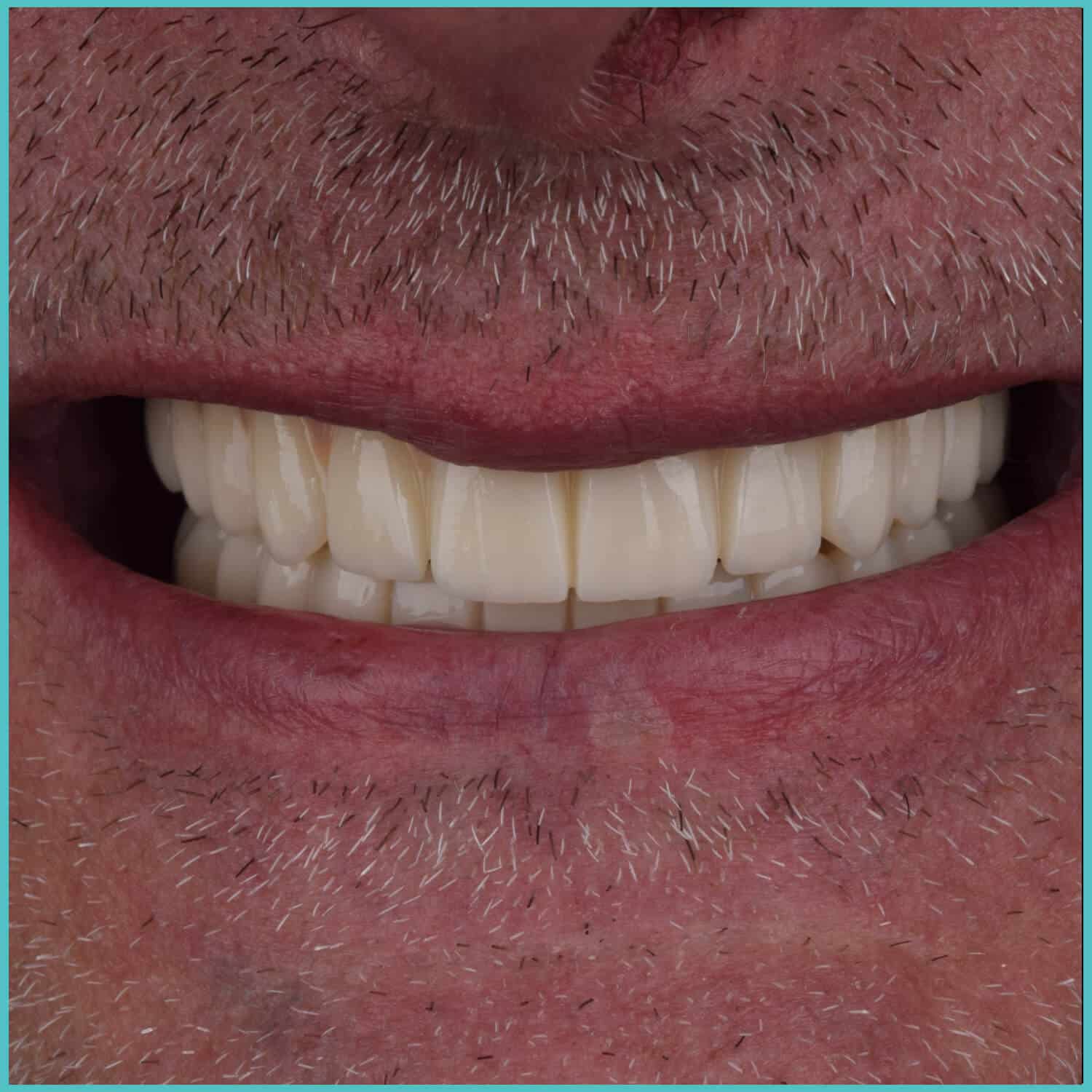 komplette zahnimplantate mit fly2smile