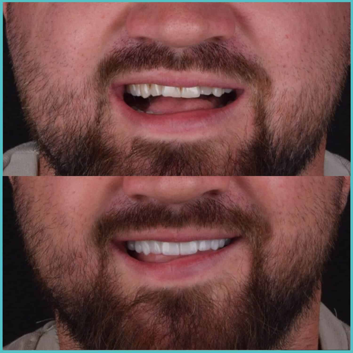 komplette zahnimplantate mit fly2smile