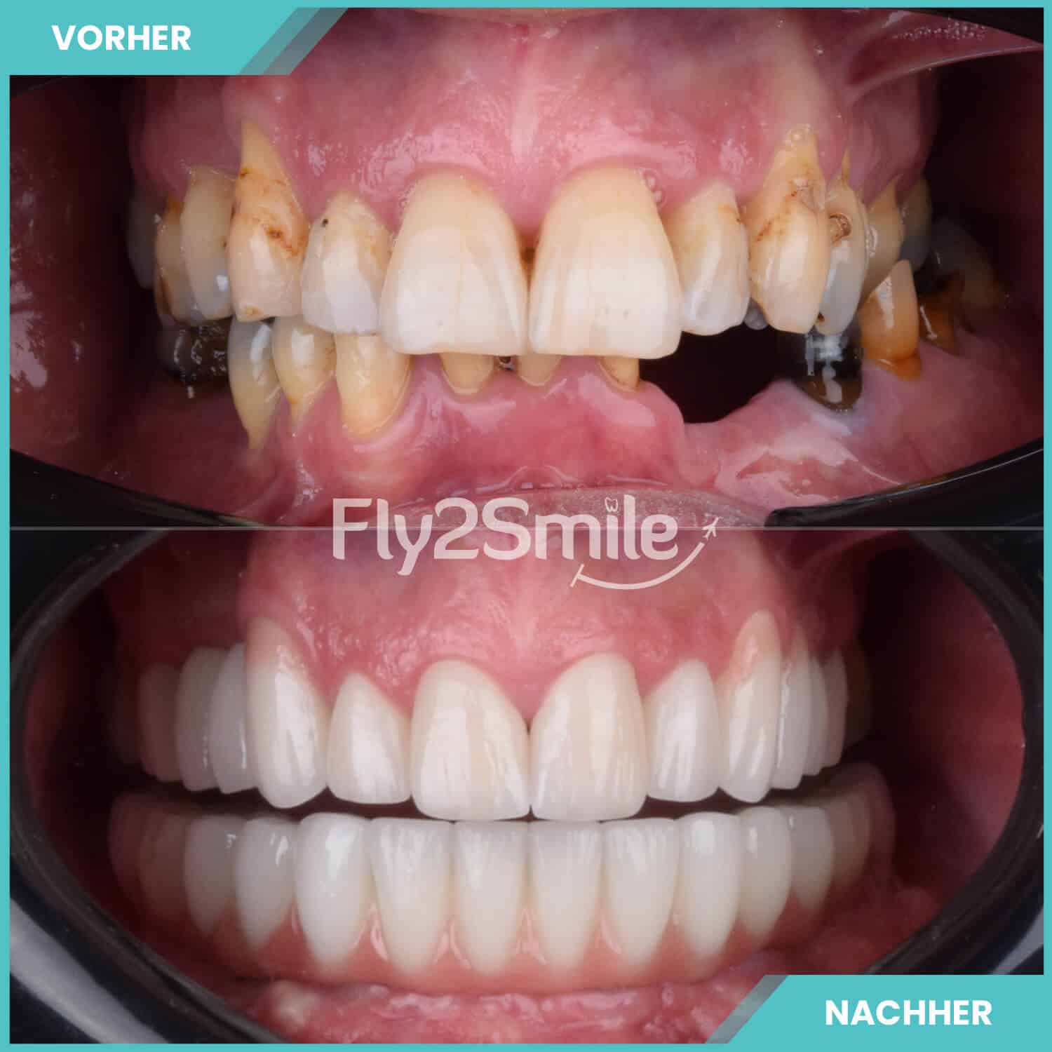 Zahnimplantat Türkei Ergebnis mit natürlichem und ästhetischem Zahnersatz