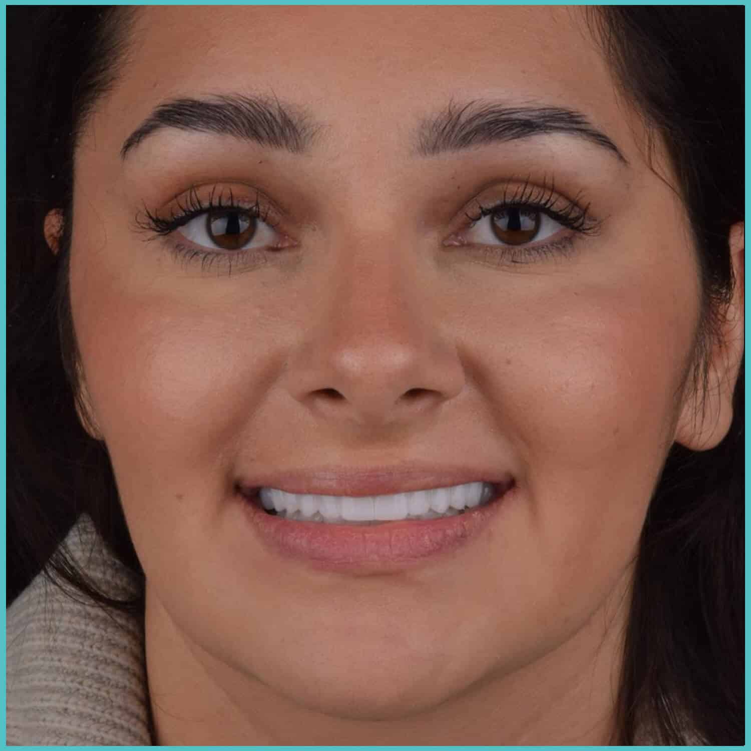 komplette zahnimplantate mit fly2smile