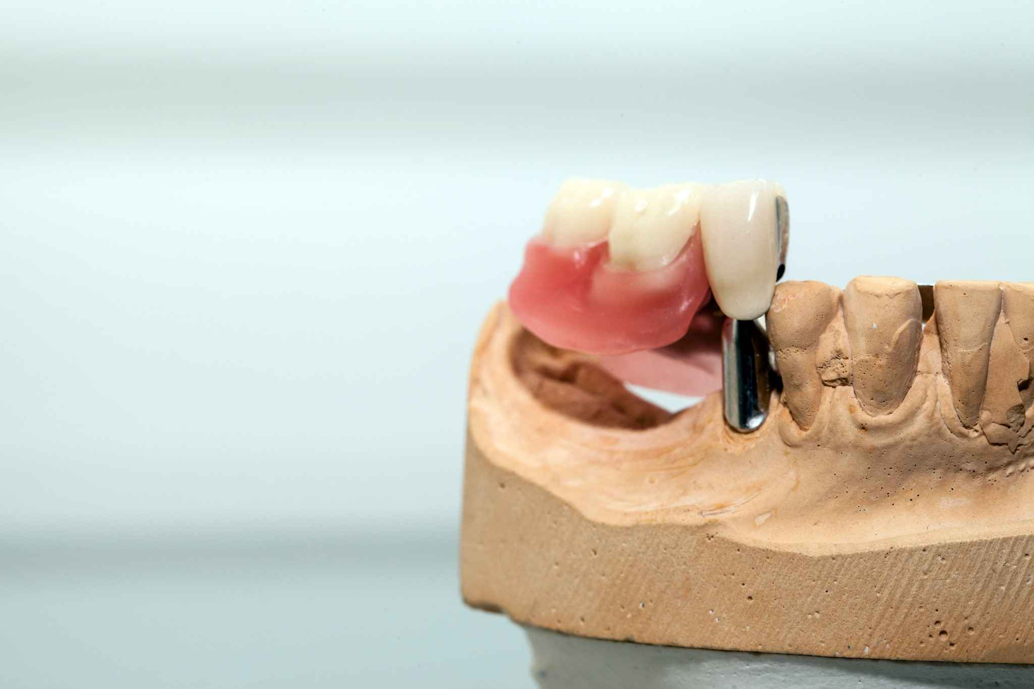 All-on-4 herausnehmbar – implantatgetragener Zahnersatz