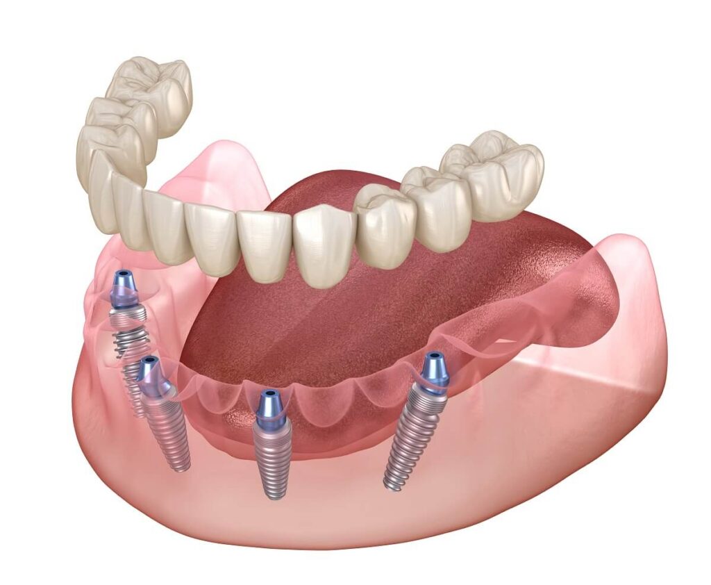 All-on-4 in der Türkei für feste Zähne und implantatgetragenen Zahnersatz an einem Tag