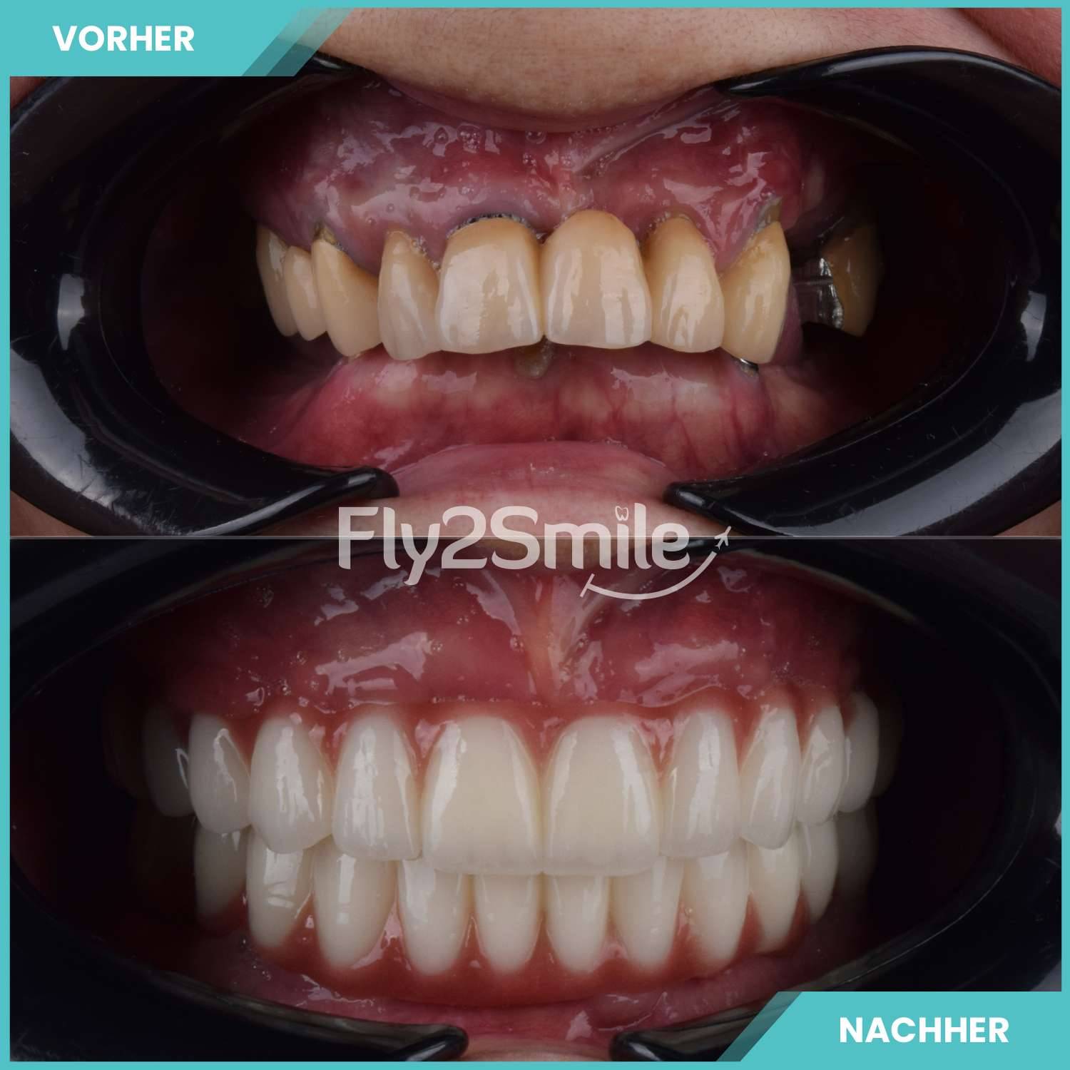 All-on-4 in der Türkei für feste Zähne und implantatgetragenen Zahnersatz an einem Tag