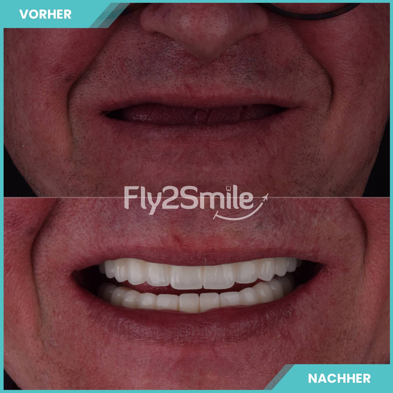 All-on-6 Zahnimplantate Vorher-Nachher Ergebnis mit festem und ästhetischem Zahnersatz