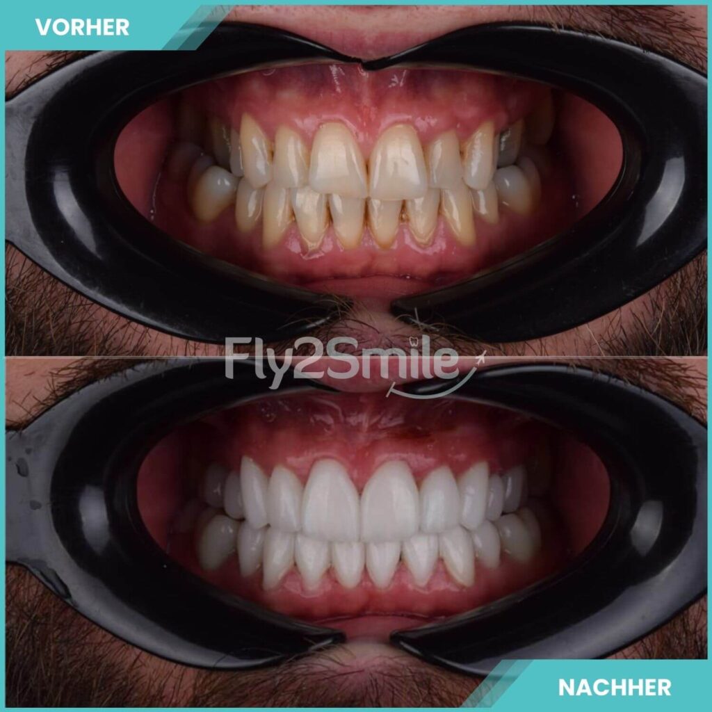 Hollywood Smile Türkei Vorher-Nachher Ergebnis mit strahlend weißen Zähnen und ästhetischer Zahnkorrektur