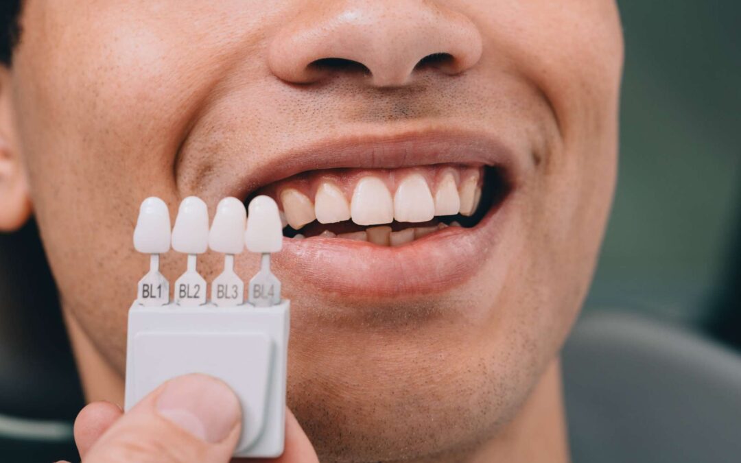 Komposit Veneers – Kosten, Ablauf und Vergleich