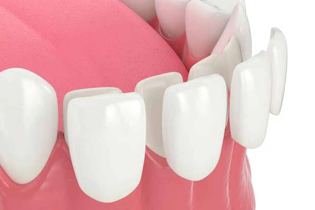 Komposit vs. Porzellan Veneers im Vergleich für ästhetische und langlebige Zahnkorrekturen