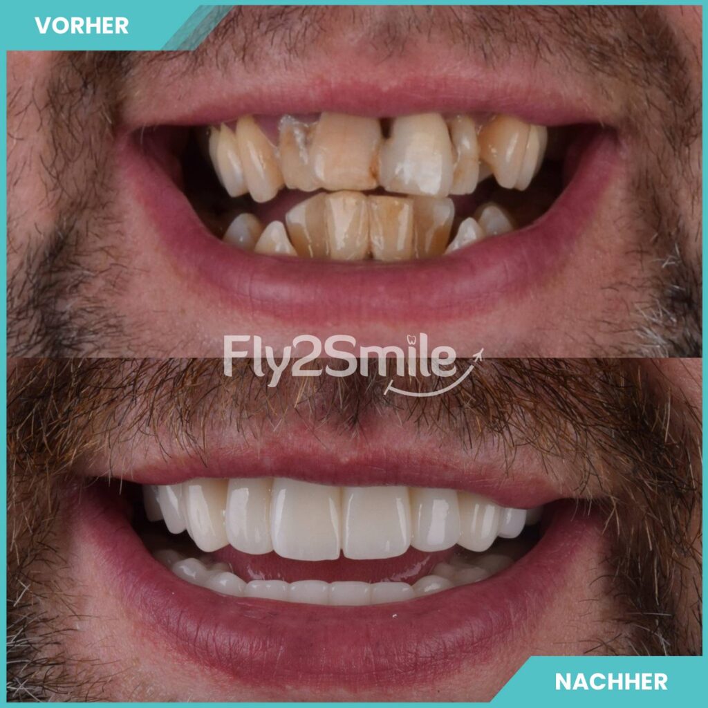 Zahnkronen Vorher-Nachher Ergebnis mit ästhetischem, natürlichem und langlebigem Zahnersatz