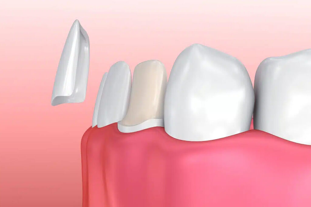Non-prep Veneers Simulation für ein natürliches Lächeln ohne starkes Abschleifen der Zähne
