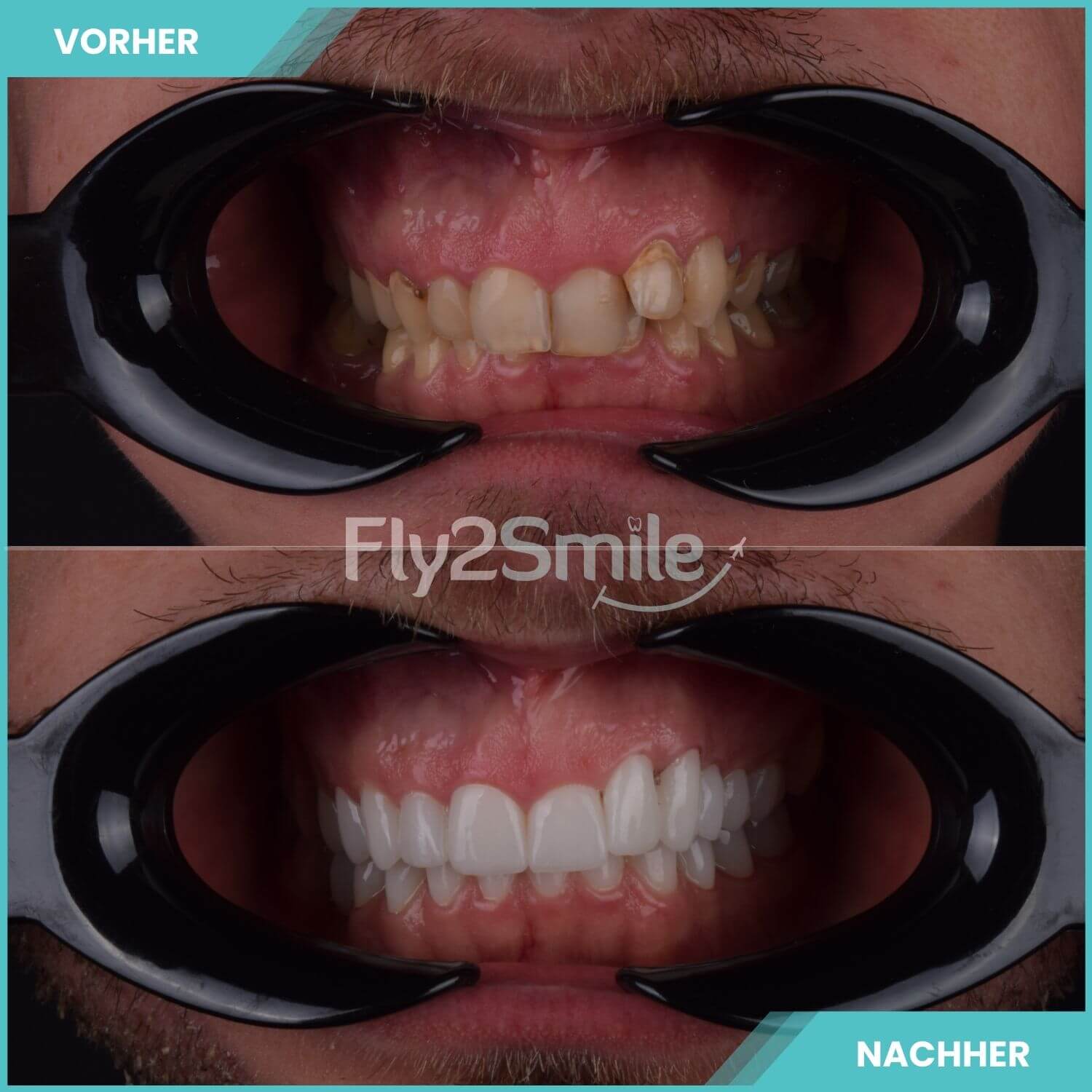 Smile Makeover Türkei Vorher-Nachher Ergebnis mit ästhetischer Zahnbehandlung und neuem strahlenden Lächeln