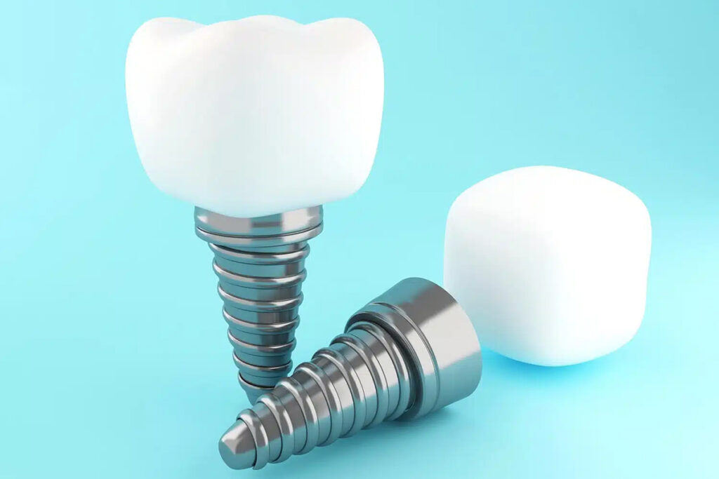 Straumann Implantat Erfahrungen mit hochwertigen Zahnimplantaten und langlebigem Zahnersatz