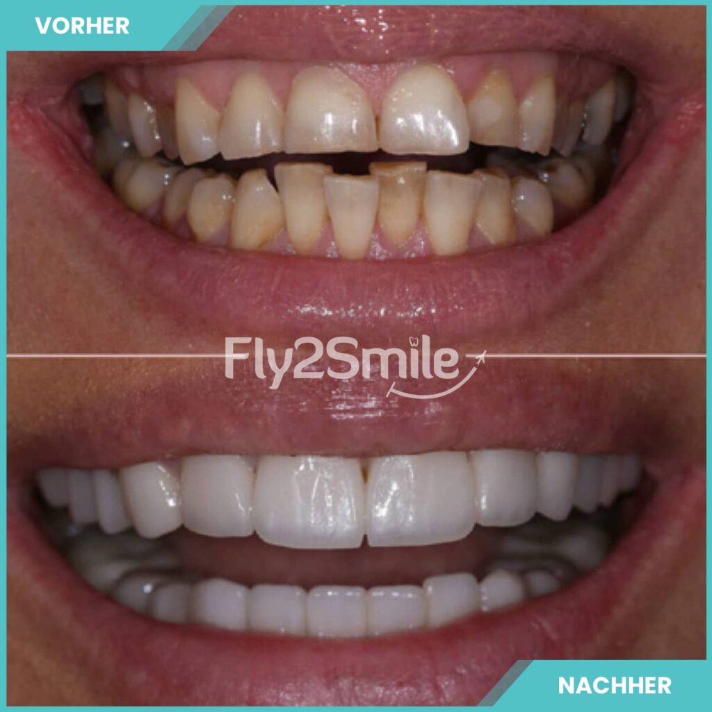 Türkei Veneers Vorher-Nachher Ergebnis mit natürlich wirkenden Zähnen und strahlendem Lächeln