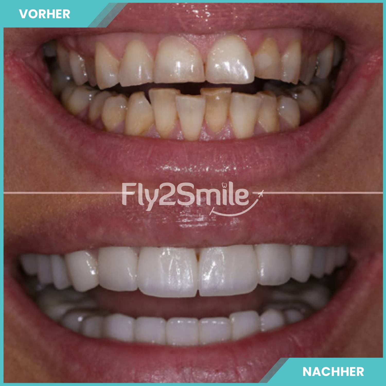 Türkei Veneers Vorher-Nachher Ergebnis mit natürlich wirkenden Zähnen und strahlendem Lächeln