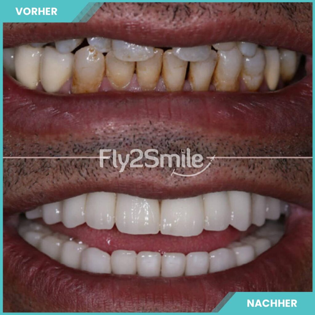 Türkische Veneers Vorher-Nachher Ergebnis mit ästhetischer Zahnkorrektur und strahlendem Lächeln