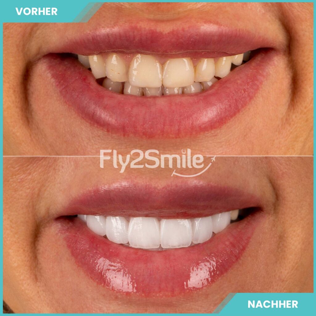 Veneers Ergebnis Vorher-Nachher mit natürlich wirkenden Zähnen und ästhetischem Lächeln
