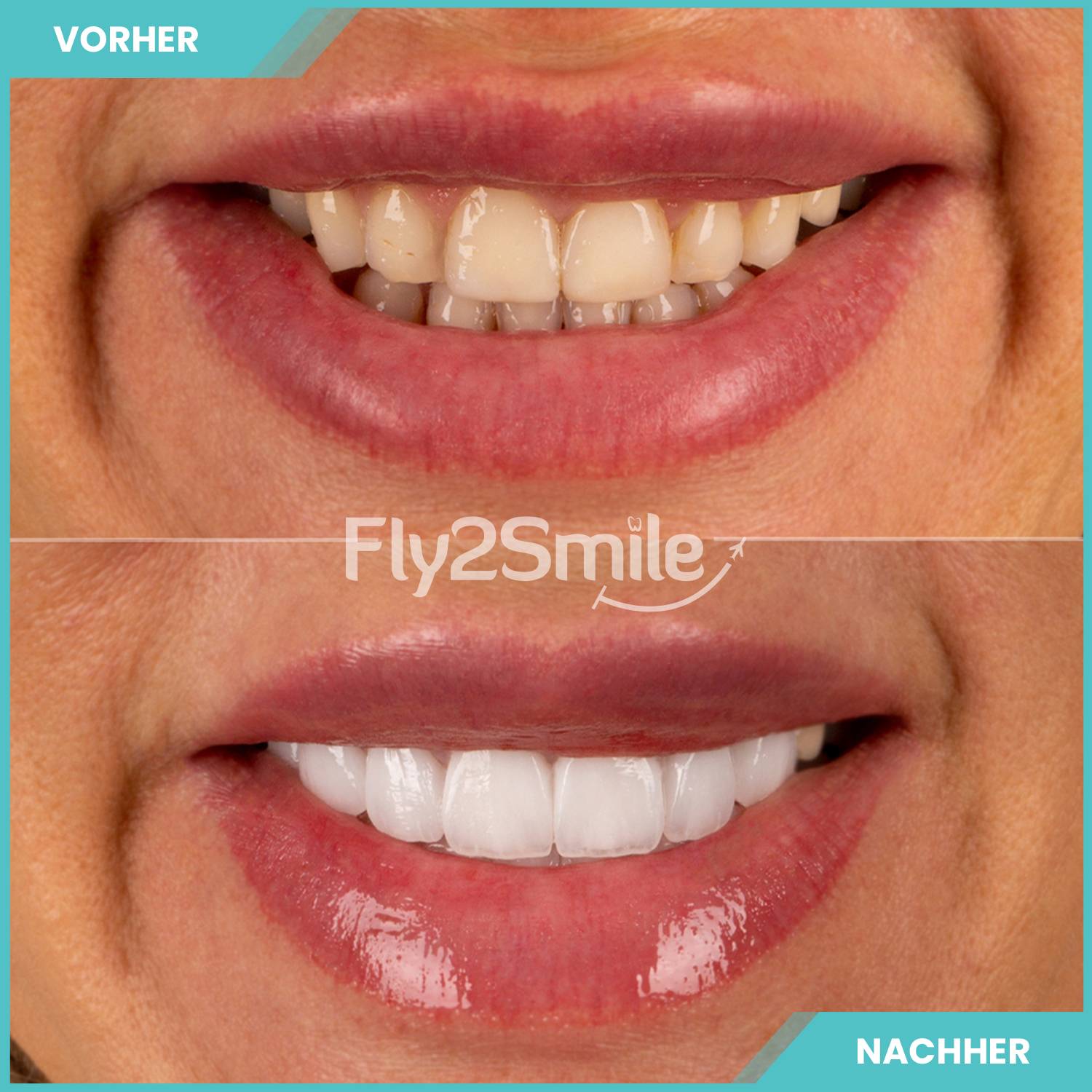 Veneers Ergebnis Vorher-Nachher mit natürlich wirkenden Zähnen und ästhetischem Lächeln