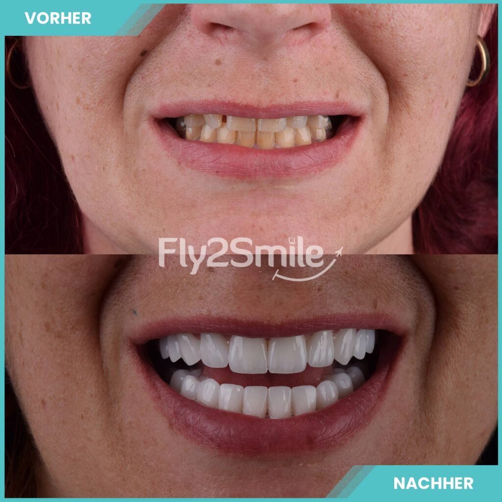 Veneers in der Türkei für ein strahlendes Lächeln und natürlich schöne Zähne